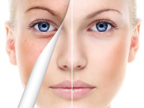 Dermal Fillers