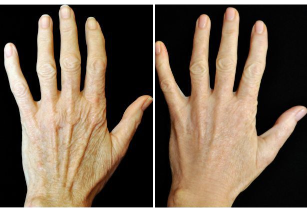 How to get younger looking hands with Radiesse fillers