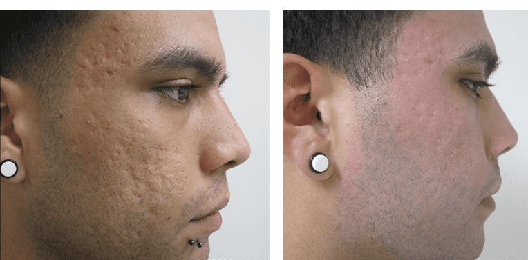 Fractional co2 Laser. Laser scar before after. Лазер фраксель постакне. Шлифовка со2 лазером постакне.