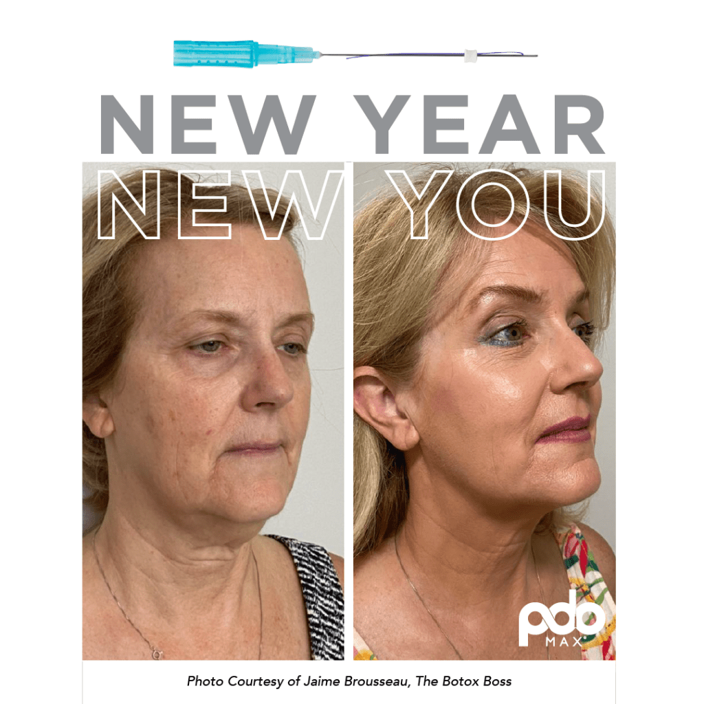 Hush L.A. Medspa - 🤫Some Clients may not be the best candidates for Botox  😳 🧵MINT PDO threads are the best alternative for minimally invasive  treatments for correction of eyebrow asymmetry, improvement