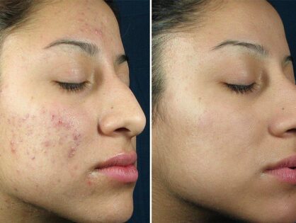Amazing benfits of Microneedling