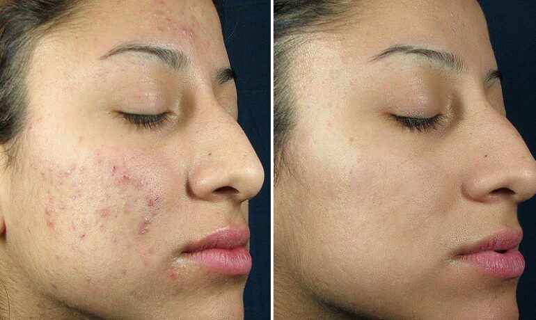 Amazing benfits of Microneedling