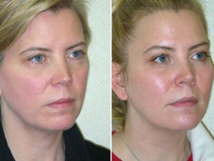 Do I Need a Chemical Peel?