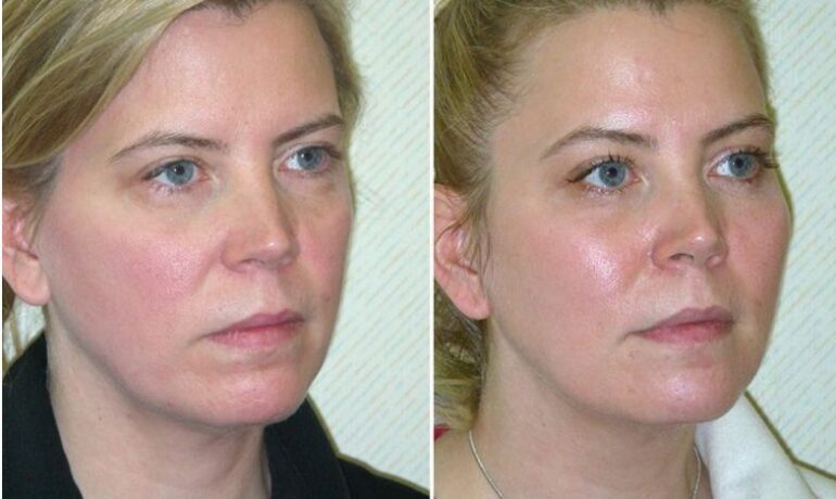 Do I Need a Chemical Peel?