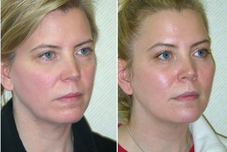 DERMAL FILLERS