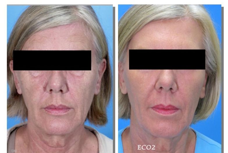 FRACTIONAL CO2 LASER