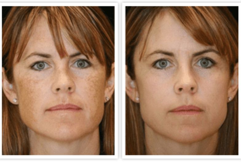 IPL or PHOTOFACIAL