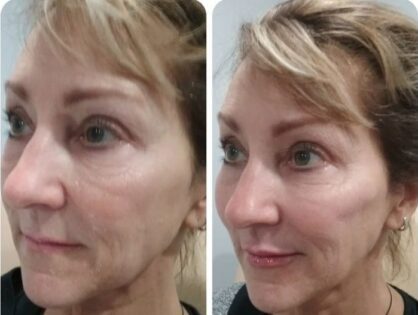 Top 5 Benefits of BOTOX
