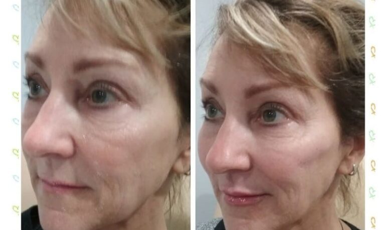 Top 5 Benefits of BOTOX