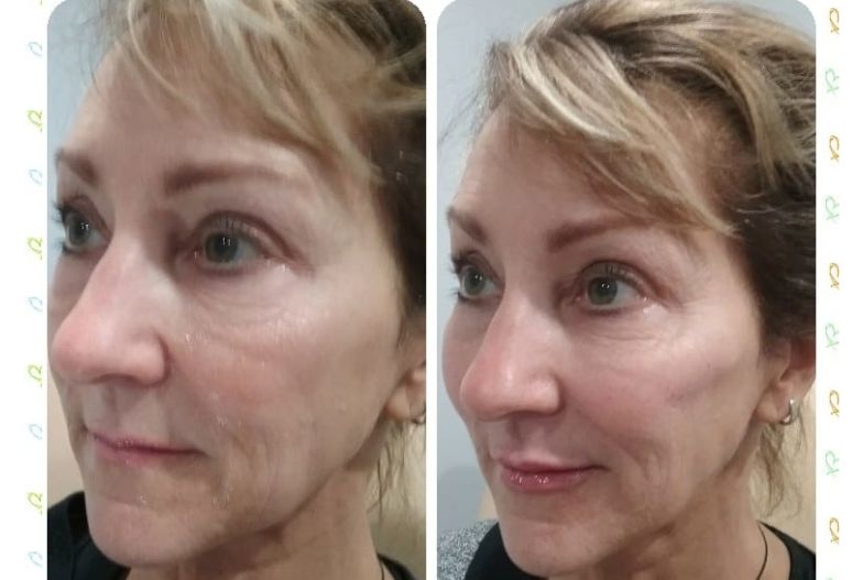 PIXEL FRACTIONAL RESURFACING