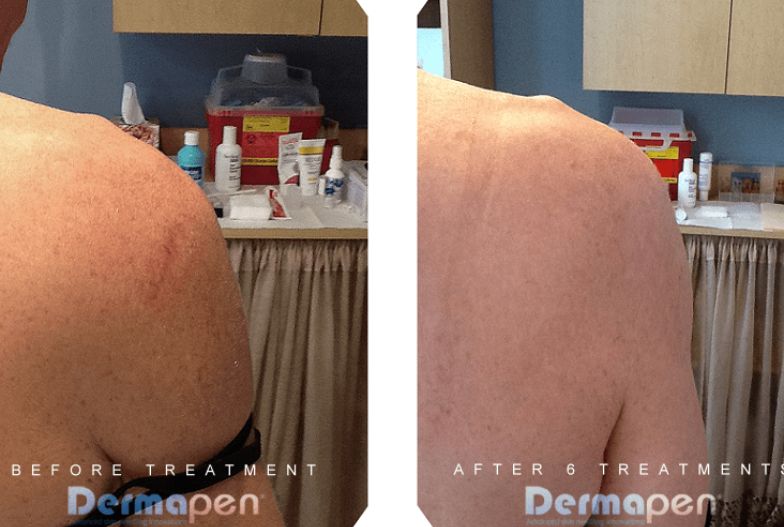 SCAR REPAIR & STRETCH MARK REMOVAL